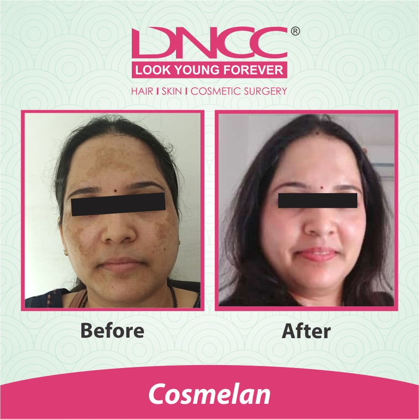 Hair Transplant Transformation 1